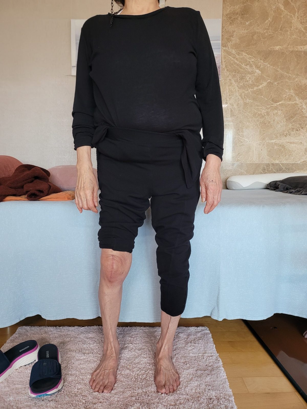 무릎 인공관절 수술 후 재활 사례(2) 대표 사진